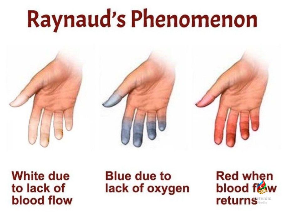 Raynaud fenomeni — 80–95%