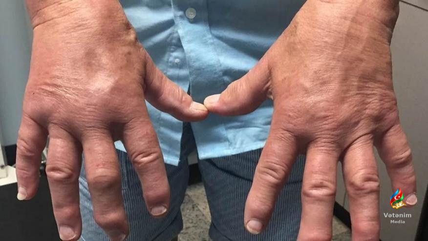 Oynaqlar və əl deformasiyaları bölməsində göstərilmiş klinik nümunə.